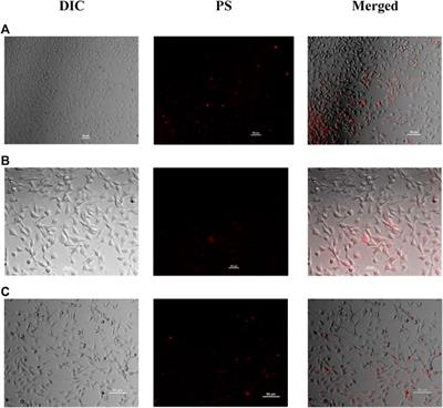 The Surprisingly Positive Effect of Zinc-Phthalocyanines With High Photodynamic Therapy Efficacy of Melanoma Cancer